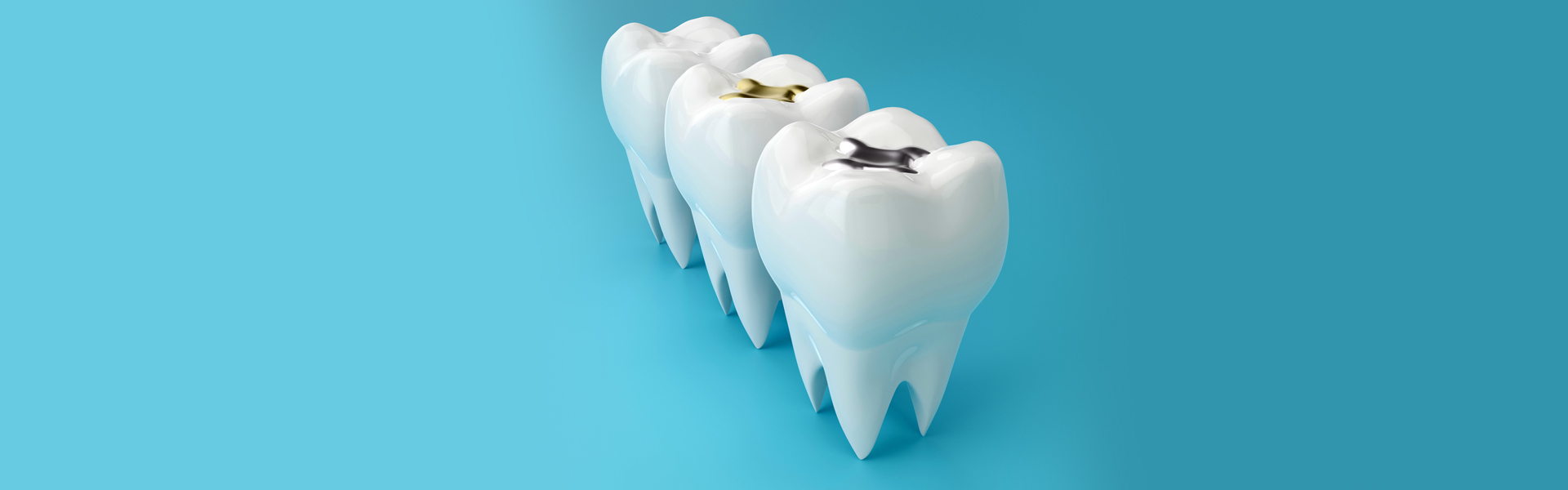 Dental Fillings